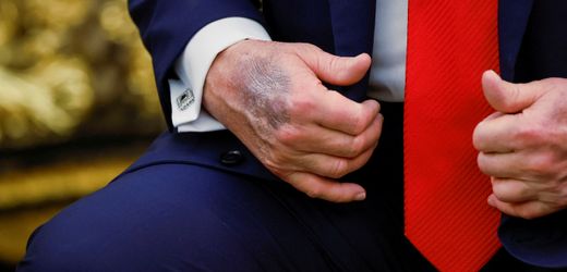 Donald Trump: Was könnte hinter dem Bluterguss an der Hand stecken?