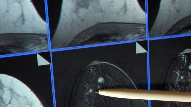 Tödlicher Mammographie-Skandal in Spanien: Mindestens 2000 Frauen nicht über Krebs-Verdachtsfälle informiert