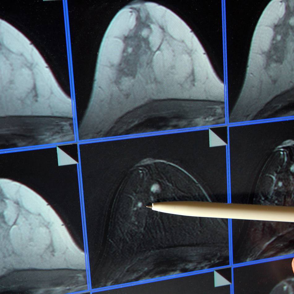 Tödlicher Mammographie-Skandal in Spanien: Mindestens 2000 Frauen nicht über Krebs-Verdachtsfälle informiert